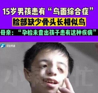 ​“鸟面综合症”是什么病？