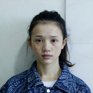 ​激光祛除痘印 再漂亮的小姐姐也会被痘印困扰，治疗完后感叹激光治疗效果真不错