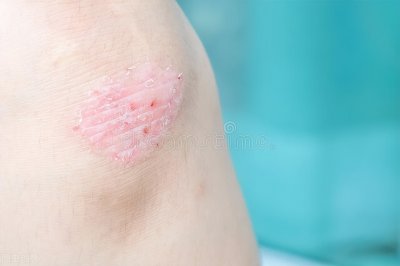 ​银屑病的症状 红斑、鳞屑还有丘疹？怕是被牛皮癣“盯”上了，如何治疗才靠谱？