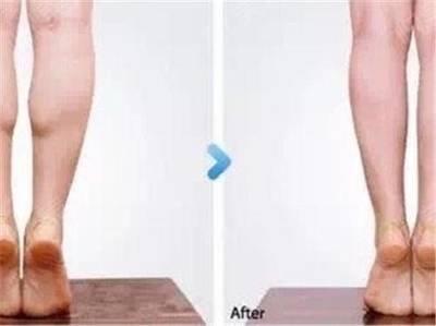 大象腿怎么形成的 大象腿会遗传吗