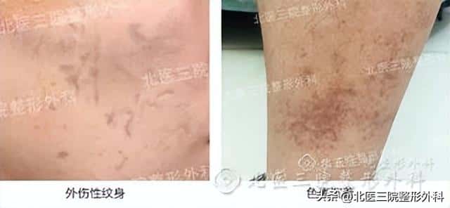 医院的清创是什么意思(清创是什么意思)