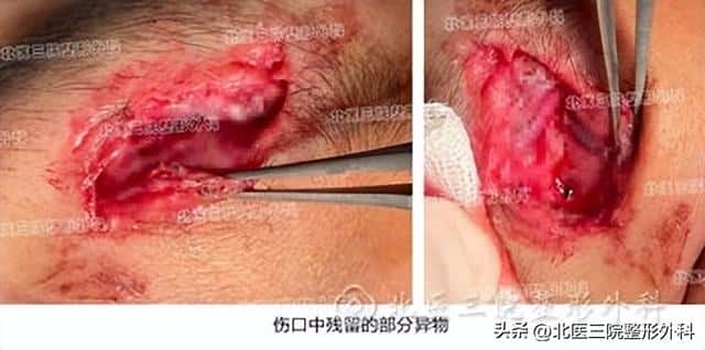 医院的清创是什么意思(清创是什么意思)