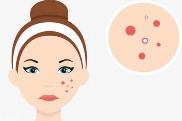 痘痘分几种类型呢 不同类型的痘痘应该怎么去除呢