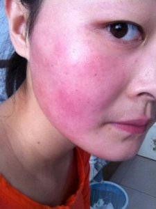 ​化妆品过敏怎么办