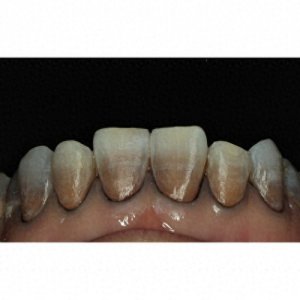 ​四素环牙到底是什么？它又是如何形成的？