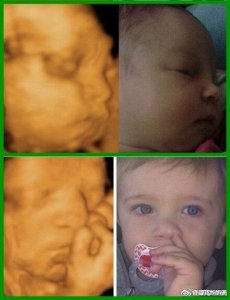 ​胎儿四维B超影像与宝宝出生后的对比图！