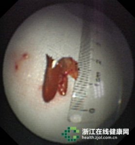 ​“肺炎”久治不愈 竟是呛进气管辣椒皮惹祸